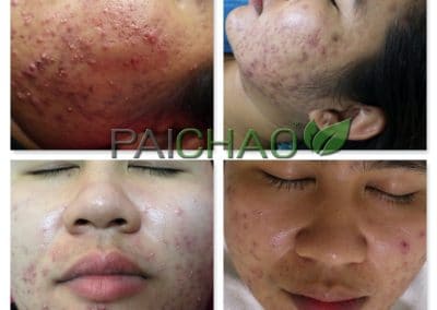 รักษาสิว