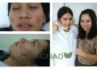 รักษาสิว